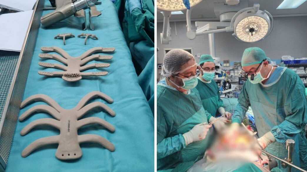 Custom 3D-printed chest implant beside the Beilinson Hospital surgical team